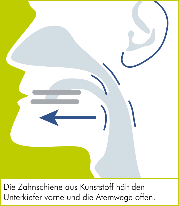 Schnarcherschiene